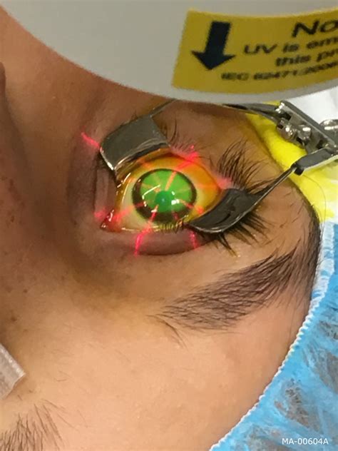 Keratoconus Corneal Ectasia Eye Care Center Of Napa Valley