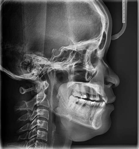 Dent In Skull Top Of The Head Forehead Back Of The Head Causes