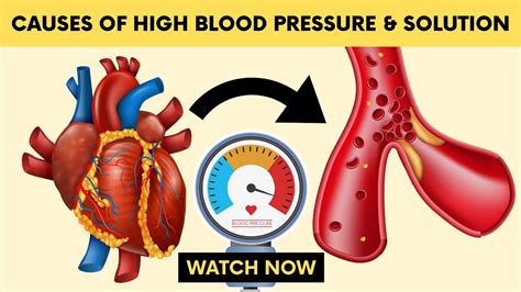 Top Causes Of High Blood Pressure And How To Prevent It Without
