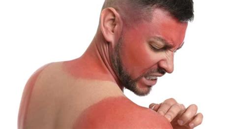 What Are The Causes And Prevention Of Sunburn Times Drop