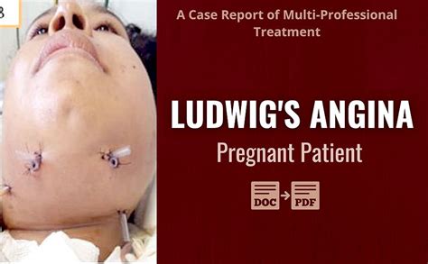Pdf Ludwigs Angina In Pregnant Patient A Case Report Of Multi