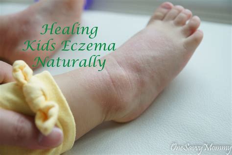 7 Steps In Healing Kids Eczema Naturally One Savvy Mommy