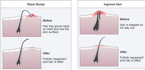 Ways To Remove An Ingrown Hair Info You Should Know