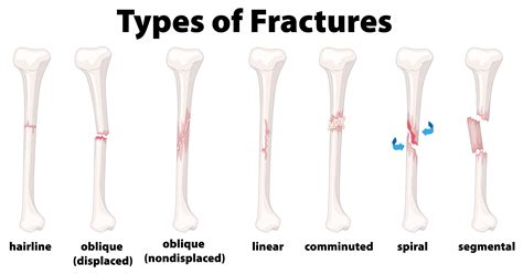 Types Of Fracture Fracture Bone Set Infographics Vect Vrogue Co