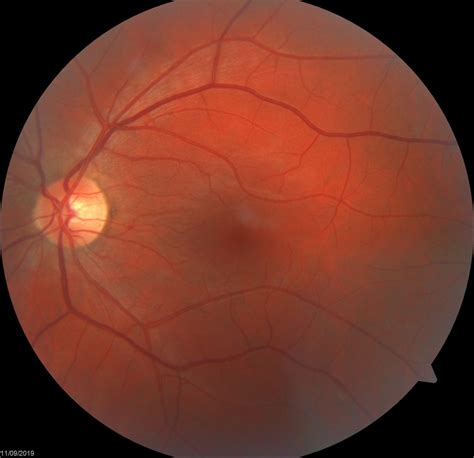 Macula And Retinal Conditions Image Gold Coast And Tweed Eye Doctors