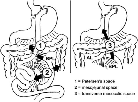 Two Similar Cases Of Internal Hernia After Laparoscopic Roux En Y Gastric Bypass Surgery Bmj