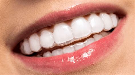 Invisalign Liverpool Invisible And Clear Braces Cost £7351pm