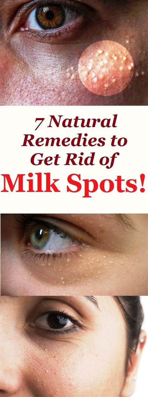 7 Natural Remedies To Get Rid Of Milk Spots These Milk Spots Often