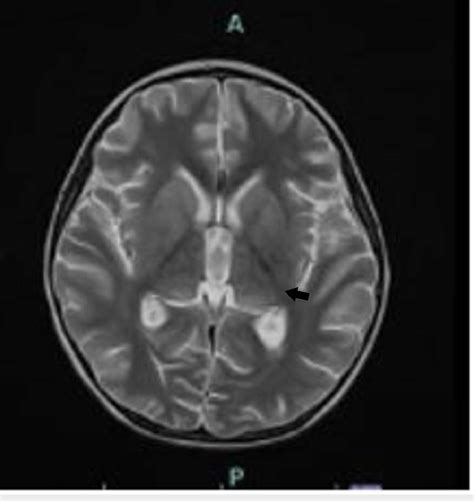 Axial T2 25 Days Later Shows Resolution Of Mri Changes Normal