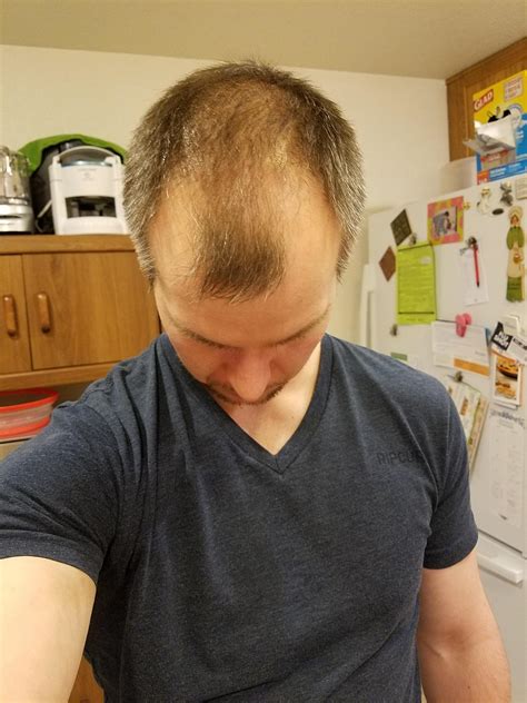 Hairline has been receding for a while now but the thinning and lose of