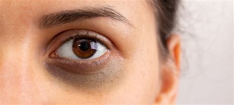 How To Get Rid Of Dark Circles And Under Eye Bags Toronto Laser Clinics