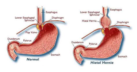 Hiatal Hernia The Great Mimic Common Condition That Causes Digestive