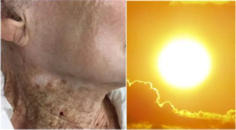 This Woman Wore Sunscreen On Her Face But Not Neck For 40 Years And