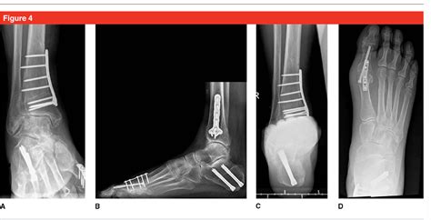 Figure 4 From Supramalleolar Osteotomies For The Treatment Of Ankle