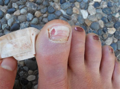 What To Do When Big Toe Nail Is Falling Off Unique And Different