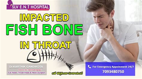 Impacted Fish Bone In Throat Youtube