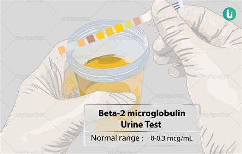 Beta 2 Microglobulin Urine Test Procedure Purpose Results Normal Range Cost Price Online