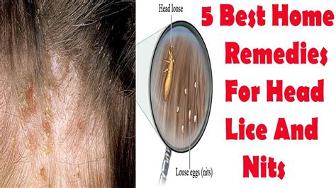 Head Lice Natural Treatment 5 Best Home Remedies For Head Lice And