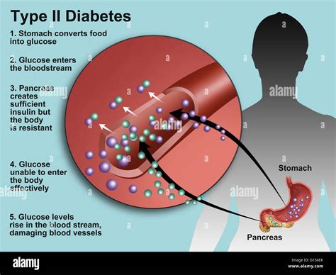 Llustration Of Insulin And Glucose Production In Type 2 Diabetes Insulin Is Produced By Islet
