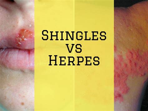Shingles Vs Herpes How Are They Different From One Another