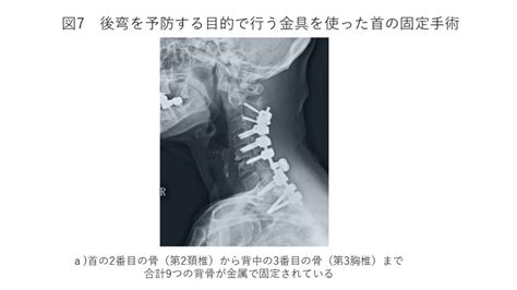 首の骨のカーブ あるべき自然な形 その1｜白石脊椎クリニック