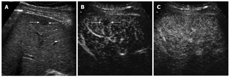 Contrast Enhanced Ultrasound In The Diagnosis Of Nodules In Liver Cirrhosis