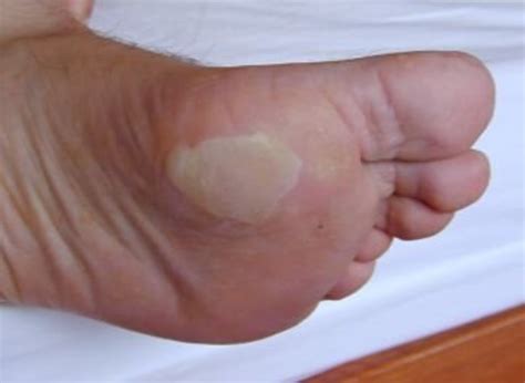 Blisters Causes And Treatment Youmemindbody