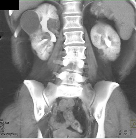 Polycystic Renal Disease Kidney Case Studies Ctisus Ct Scanning