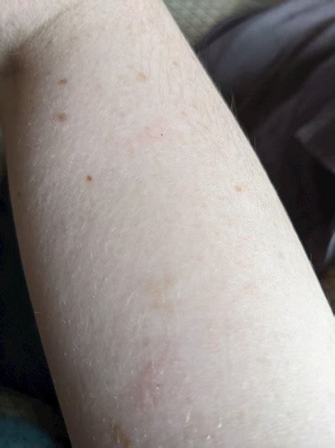 Tiny Red Dots On Arms In The Last Couple Of Months My Skin