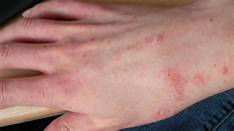 How To Clean For Scabies Relationclock27