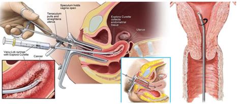 Endometrial Biopsy Procedure