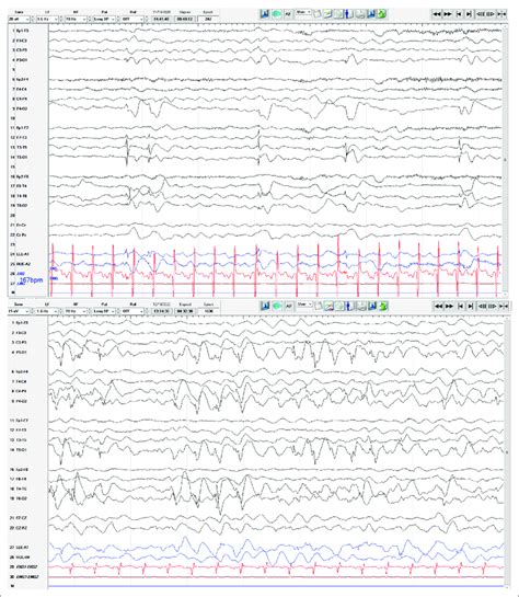 Top Routine Interictal Eeg At 6 Months Old In A 10 20 Scalp Placement