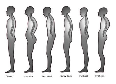 How To Fix Bad Posture Back