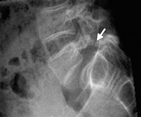 Lateral Radiograph Of The Lumbar Spine In A Patient With Type Iv