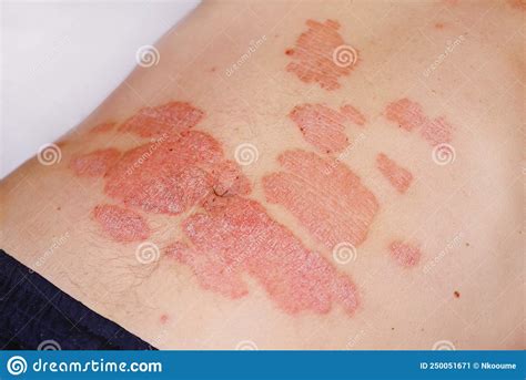 Acute Psoriasis On The Stomach In A Man Severe Redness On The Skin An