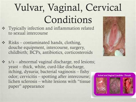 Ppt Benign Diseases Of The Vulva Vagina And Cervix The Best Porn Website