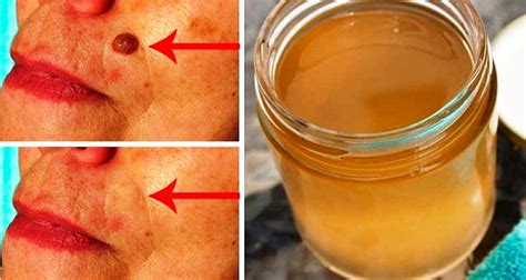 Get Rid Of Age Spots Moles Warts And Pimples In A