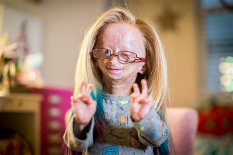 Progeria Syndrome De Vieillissement Prématuré Quest Ce Que Cest