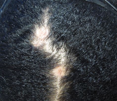 Lupus Erythematosus Tumidus Of The Scalp Masquerading As Alopecia