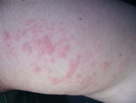 Skin Rashes That Itch All Over Body Hoplog