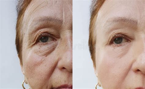 Elderly Woman Wrinkles Face Before And After Removal Dermatology
