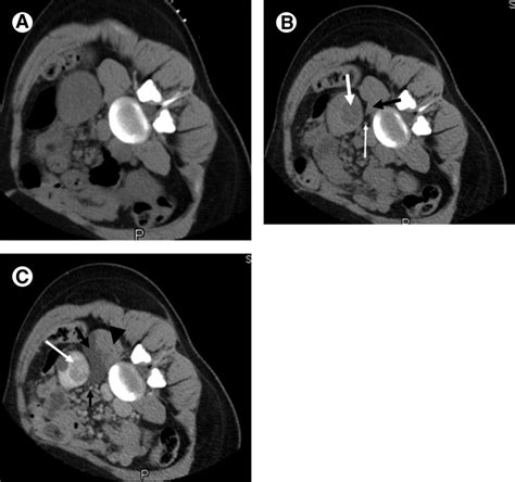 Pdf Management Of Renal Tumors By Image Guided Radiofrequency Ablation
