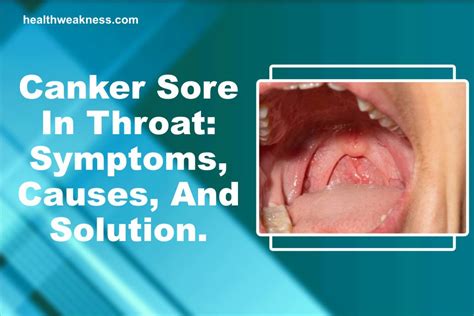 Canker Sore In Throat Symptoms Causes And Solution 2023