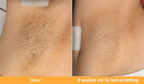 Side effects after diode laser treatment may happen but these are transient. Painless hair removal by Soprano ICE Alexandrite laser