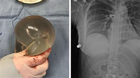 Breast Implants Save Womans Life By Deflecting Bullet Away From Her Heart