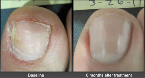 Toenail Fungus Before After Laser Treatment