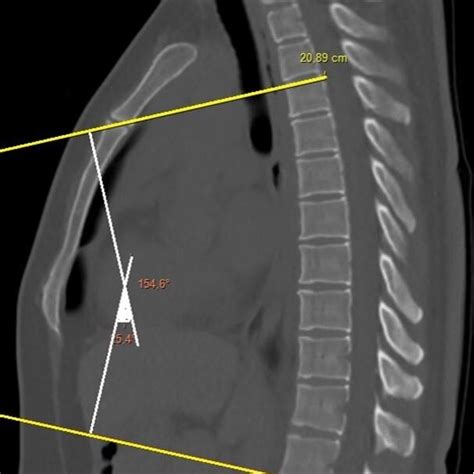 Thoracic Kyphosis Angle Measurement Technique On Sagittal Plane Thorax Download Scientific