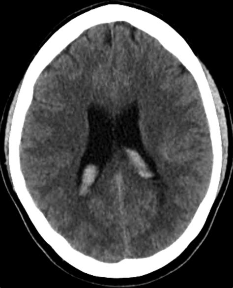 E Axial Noncontrast Head Computed Tomography Shows Intraventricular