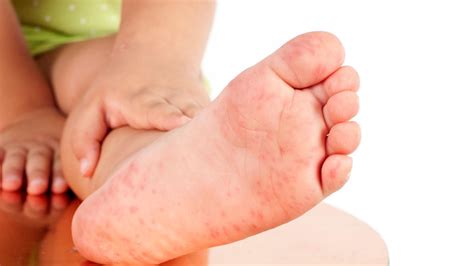 Hand Fuß Mund Krankheit Symptome Und Dauer Elternde