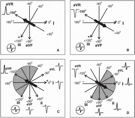 The Electrical Axis And Cardiac Rotation Basic And Bedside